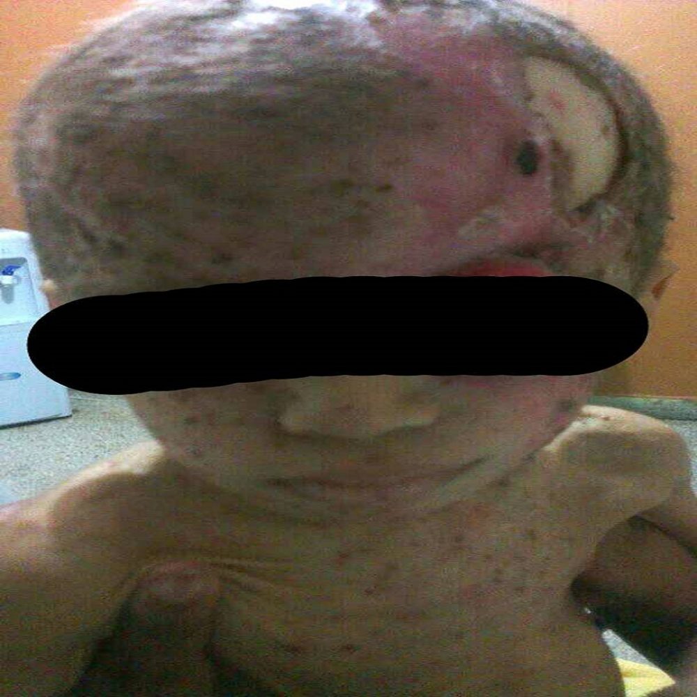 Niño maracayero tiene la mitad del cerebro expuesto por sarna  y desnutrición