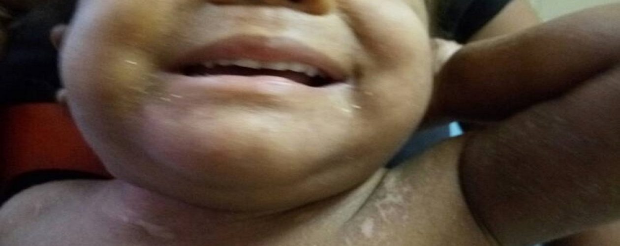 Desnutrición en Bolívar: niña queda ciega por falta de nutrientes