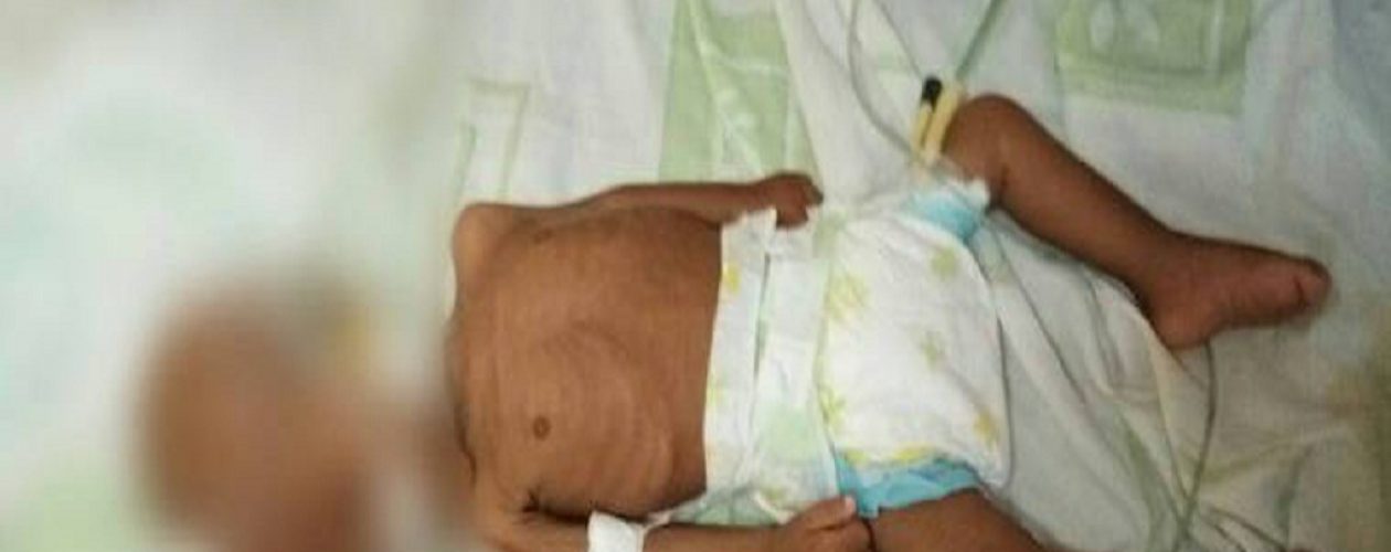 Segunda muerte por desnutrición en lo que va de mes en Guayana