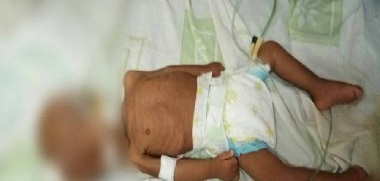 Al menos 47 niños murieron por desnutrición en Bolívar durante 2017