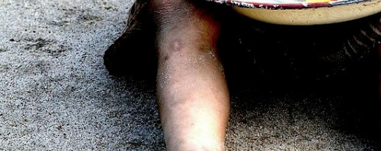 Informe revela alarmantes cifras de niños desnutridos en Venezuela
