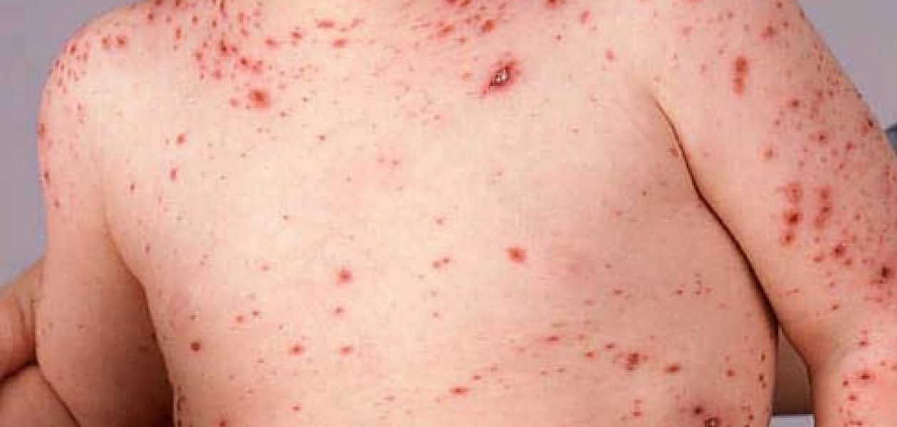 Epidemia de varicela  suma unos 100 mil casos en Venezuela
